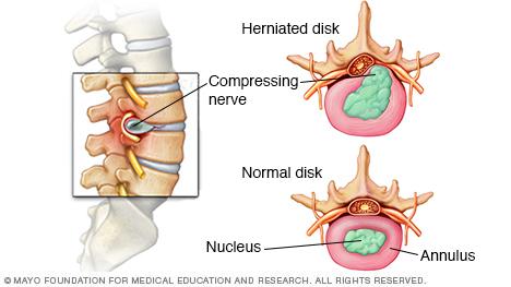 Illustration of normal and herniated spinal disk