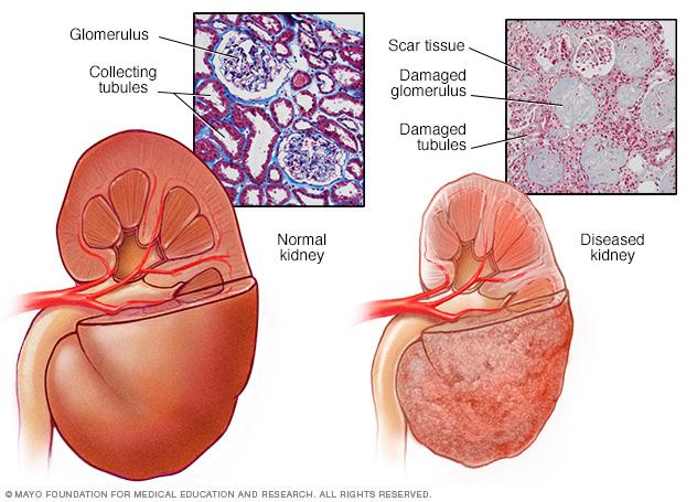 Illustration showing normal kidney compared with diseased kidney
