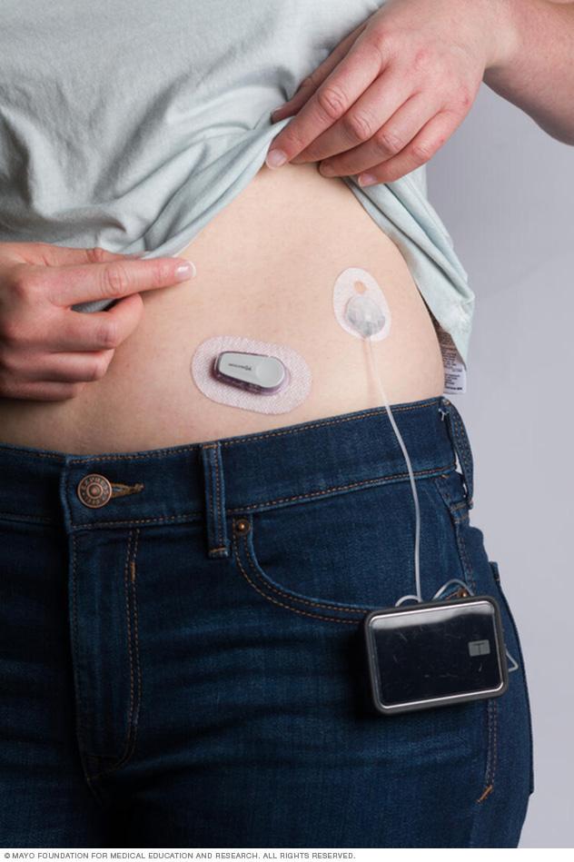 Continuous glucose monitor