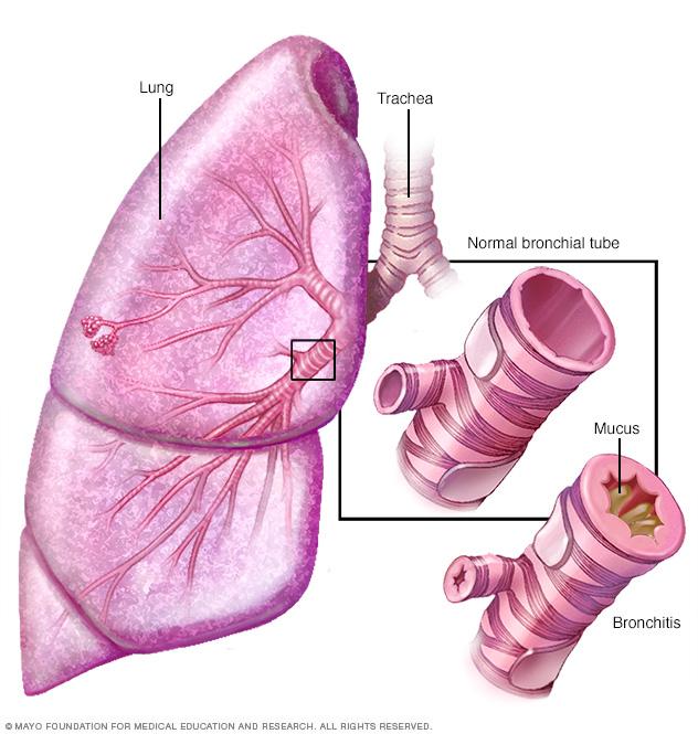 Illustration of bronchitis