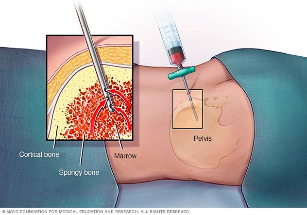 A needle suctioning out liquid bone marrow from hipbone