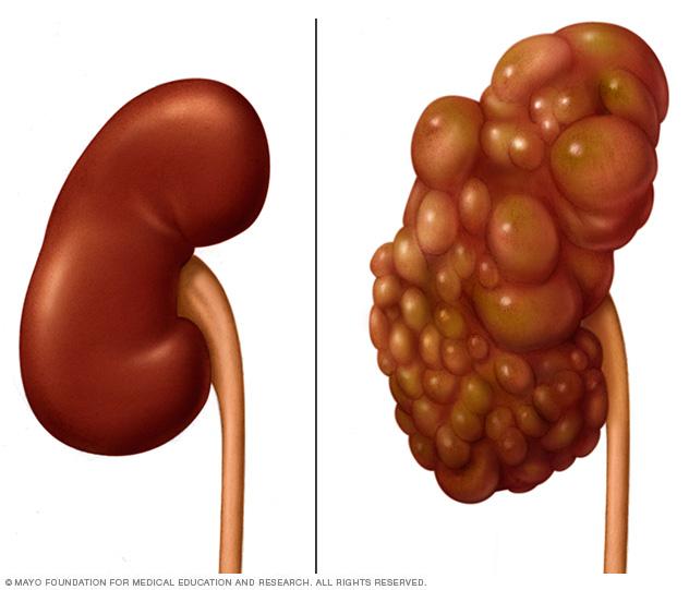 Polycystic kidney compared with normal kidney