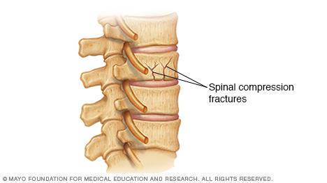 Illustration of spinal compression fractures