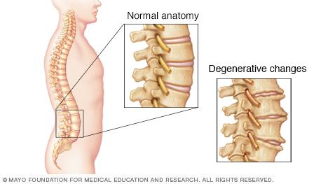 Illustration of spine with degenerative changes