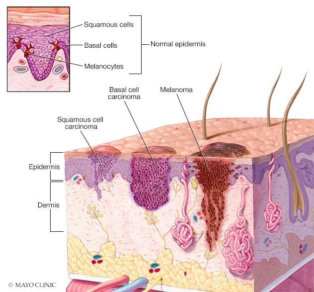 Where skin cancer develops